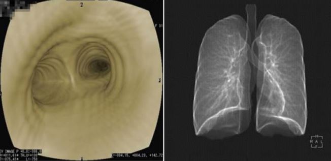 当院では、仮想気管支内視鏡検査は肺と気管支が一度に評価可能です。